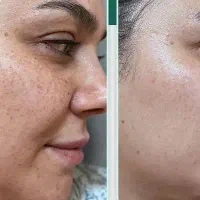 رفع لک و تیرگی پوست و تزریق ژل و بوتاکس