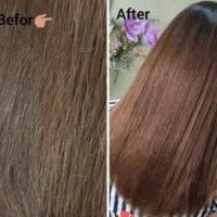 ۵۰٪ تخفیف موخوره گیری+ هیدروژن تراپی رایگان