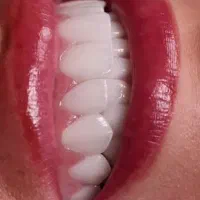طرح ویژه ارتودنسی ایمپلنت بدون پیش پرداخت با وام +