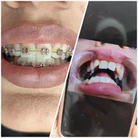 ارتودنسی اقساط بدون چک(حتما عکس ارسال کنید )