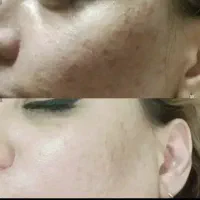 کرم  ضد لک و سفید کننده تضمینی