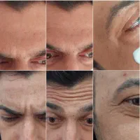 ژل پی آر پی بوتاکس مزوتراپی صورت و مو