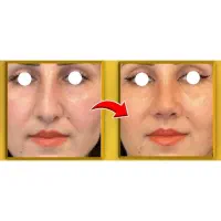 تو خونه بینی تو ۲۰ روزه کوچیک کن