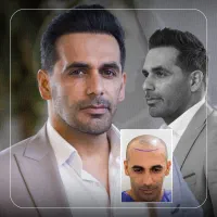 کاشت مو با بهترین شرایط