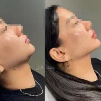 بلفاروپلاستی،لیفت کل صورت،سانترال لب( بخیه لیزری)