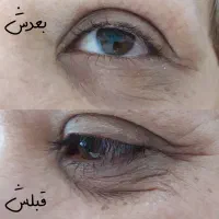 رفع پیسی چین چروک جوانسازی تیرگی پلک بدن جوش اسکار