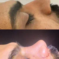 تخفیف عمل بینی