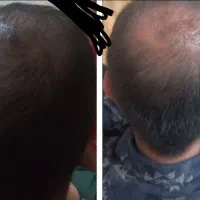 رویش مجدد موها و قطع ریزش مو