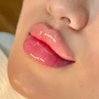 فیلر لب و صورت