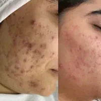 تخفیف ویژه محدودخدمات پوست ومووزیبایی