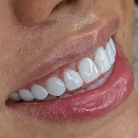 پذیرش * مدل کامپوزیت دندان *