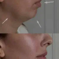 ژل و بوتاکس شرایطی