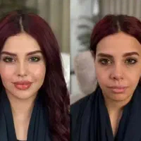 آموزش و تزریق ژل و بوتاکس،تزریق چربی،لیفت نخ و prp