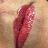 رفع کبودی لب