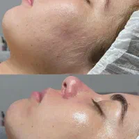 یک تیر و سه نشون، پاکسازی ، لایه برداری و اصلاح