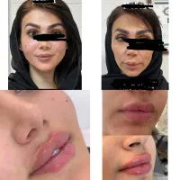 ژل لب و گونه و زاویه و فشیال