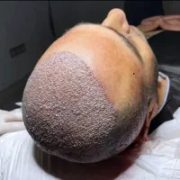 کاشتمو با تخفیف ویژه روش میکروگرفت بدون ورم وکبودی