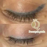 ساکشن غبغب.پی آر پی.خالبرداری.کربن تراپی.ریموو تتو