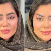 ژل.لیفت تخصصی صورت بانخ.افزایش سایزآلت تناسلی آقا