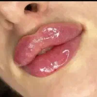 جشنواره تزریق ژل و بوتاکس ۴۵۰الی ۸۵۰