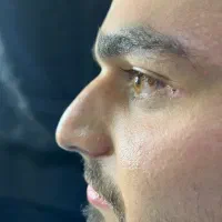 عمل بینی بدون جراحی