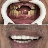 دندانپزشکی روکش ۷/۵۰۰دیجیتال