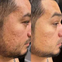 جای لک و اسکار قدیمی