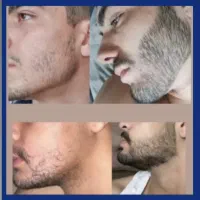 شامپو و سرم پرپشتی مو و ریش