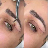 بلفاروپلاستی پلک بدون جراحی(جشنواره/فرصت نامحدود)