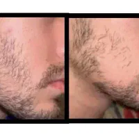 کم پشتی ریشاتو ریشکن ، کن