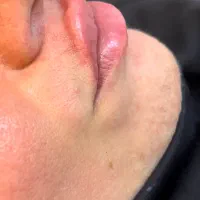 جشنواره تخفیفی ژل و بوتاکس