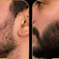 قبل از استفاده از ماینوکسیدیل اینو ببین