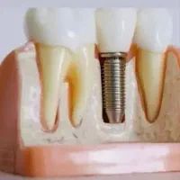 ایمپلنت کره ای با روکش
