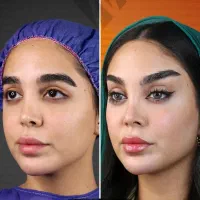 اصلاح فرم بینی بدون عمل جراحی Noaآنزیم ژل نخ ابرو