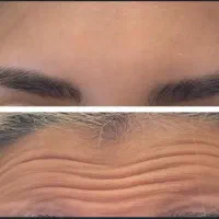 فیلر،ژل،بوتاکس،پیرسینگ،خالبرداری در سهند فاز۴