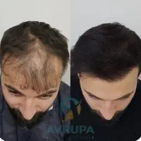 موهات کم‌پشته حتما اینو ببین