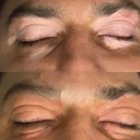 بیماری پیسی رو با ما درمان کن