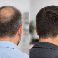 برای موهات مشاوره رایگان بگیر