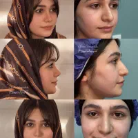 شرایط ویژه عمل بینی