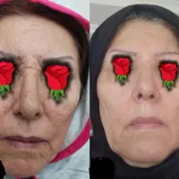 کرم بیوممتیک ۵کاره قویتر از بوتاکس قیمت‌ قبل+4هدیه