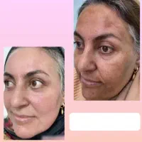رفع لک و کک و مک تنها در یک ماه تضمینی