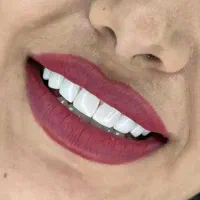 با مناسبترین قیمت لبخندتو زیباکن...