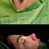 جراحی بینی/ابدومینوپلاستی/لیپوساکشن