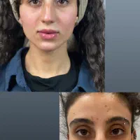 لیفت  و جوانسازی صورت بدون جراحی