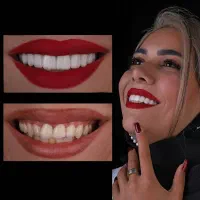 عصب کشی،کامپوزیت،روکش با اقساط بدون پیش پرداخت