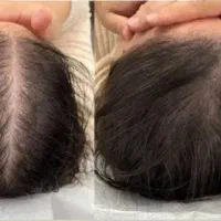 کچل و کوسه بودن خز شده