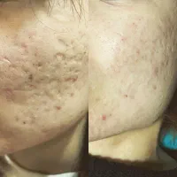 پاکسازی تیرگی بدن/رفع آکنه/جوش صورت /