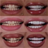 کامپوزیت/لمینت/دندانپزشکی
