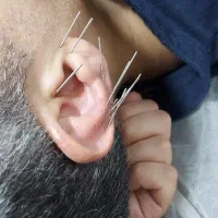 مطب طب سنتی و طب سوزنی/حجامت/بادکش/تسکین درد