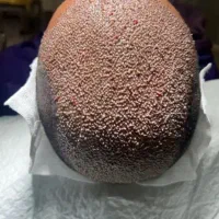 کاشت مو سر و ریش/کاشت ابرو/با تراکم طبیعی و بالا